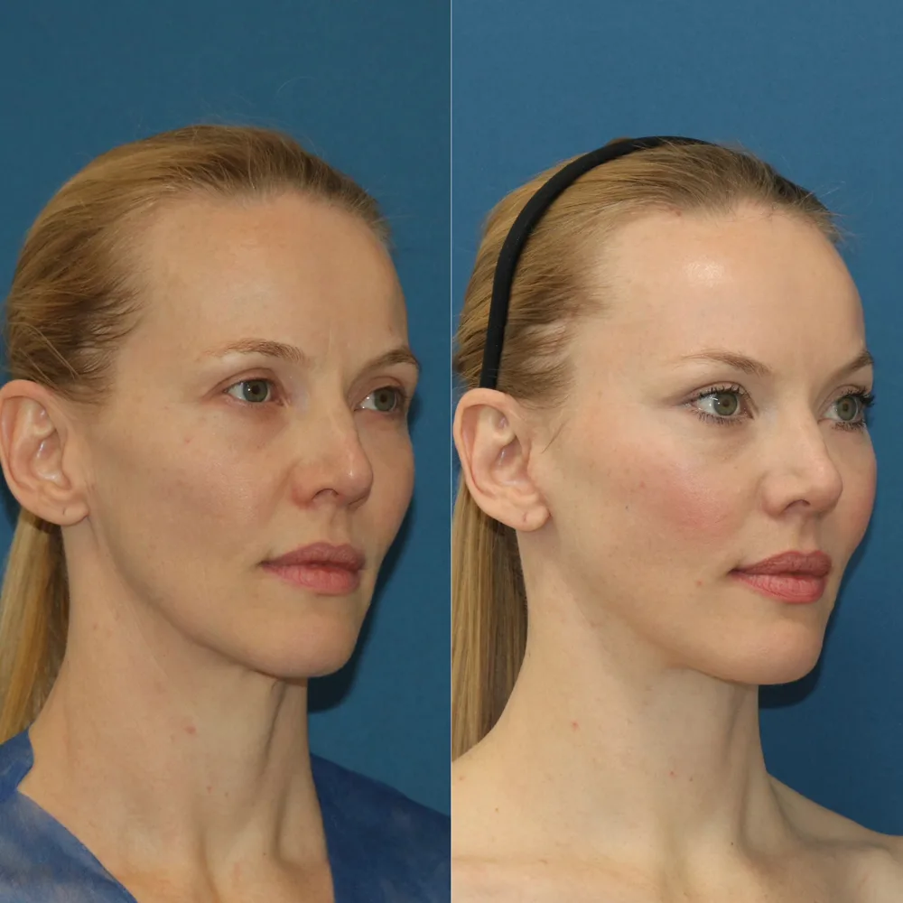 Resultado de lifting facial endoscópico